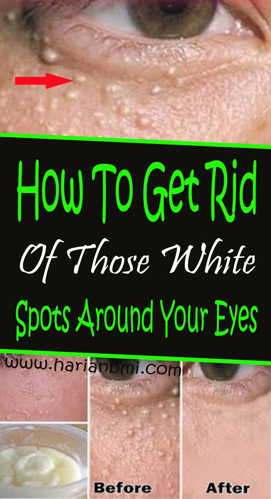 How To Get Rid Of Those White Spots Around Your Eyes Viralvzbeauty how-to-get-rid-of-those-white-spots-around-your-eyes-viralvzbeauty