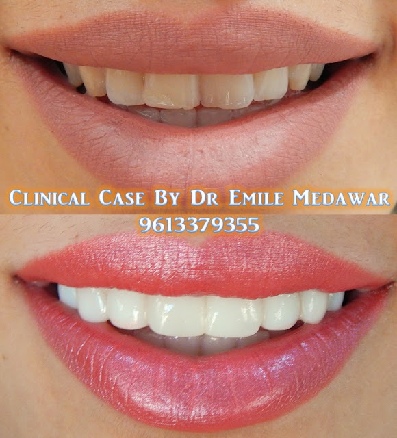 Beirut Veneer, Dr Emile Medawar, 00 961 3 379355 Veneers are used to