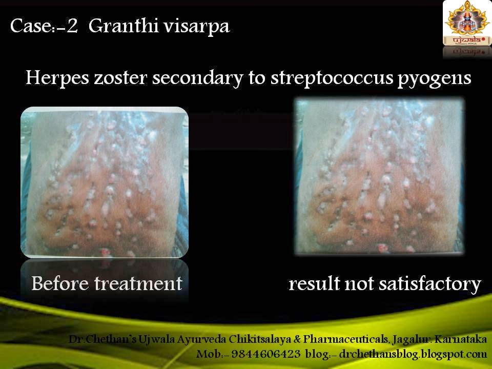 Dr.Chethan's Ayurvedic Remedies Ayurvedic Medicine for Herpes