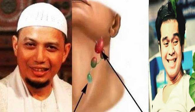 MENGENAL KANKER KELENJAR GETAH BENING PENYEBAB USTADZ ARIFIN ILHAM DAN OLGA SAPUTRA MENINGGAL MENGENAL KANKER KELENJAR GETAH BENING PENYEBAB USTADZ ARIFIN ILHAM DAN OLGA SAPUTRA MENINGGAL