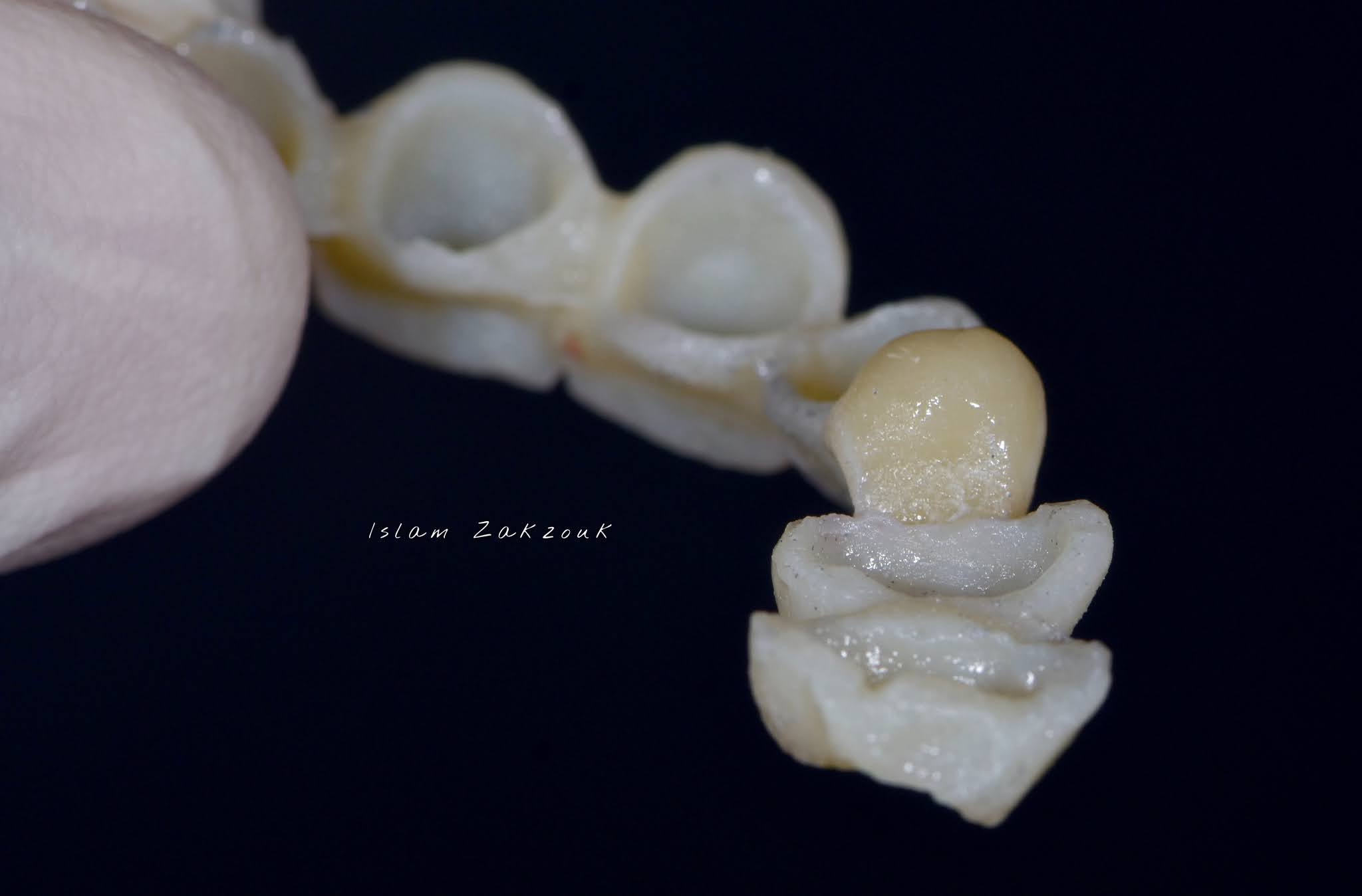 Dental Esthetics Ovate pontic for the correct emergence profile.. A clinical case