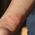 Κουνούπια: Τα κόλπα πριν βγείτε έξω για να μην σας τσιμπάνε