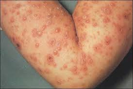 Jual Obat Gatal di Sekujur Badan Jual Obat Gatal di Sekujur Badan