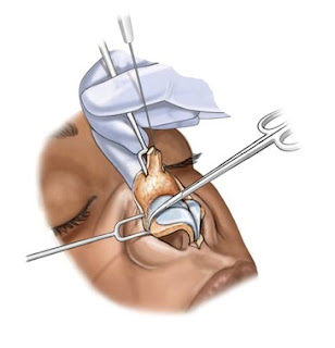 Open technique rhinoplasty