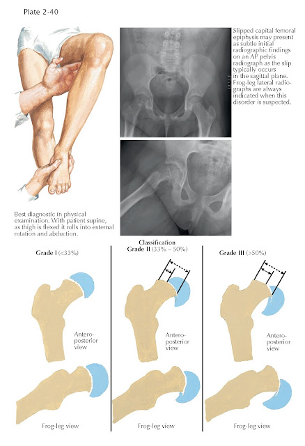PHYSICAL EXAMINATION AND CLASSIFICATION OF SLIPPED CAPITAL FEMORAL EPIPHYSIS