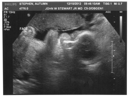 Stella's Ultrasound Image