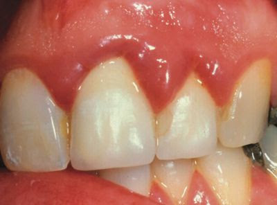 Tìm hiểu nguyên nhân khi làm răng sứ bị viêm lợi