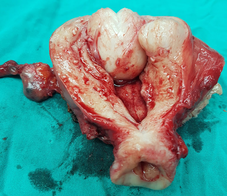 Submucus and intramural fibroids - TAH and RT. salpingo-oophorectomy done by Dr. Alaa Mosbah