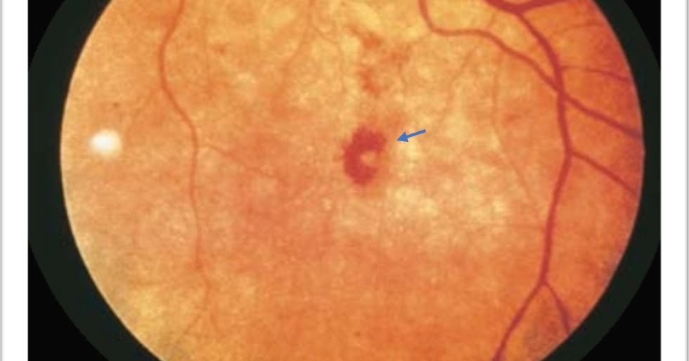 What are the causes of Roth's spots?
