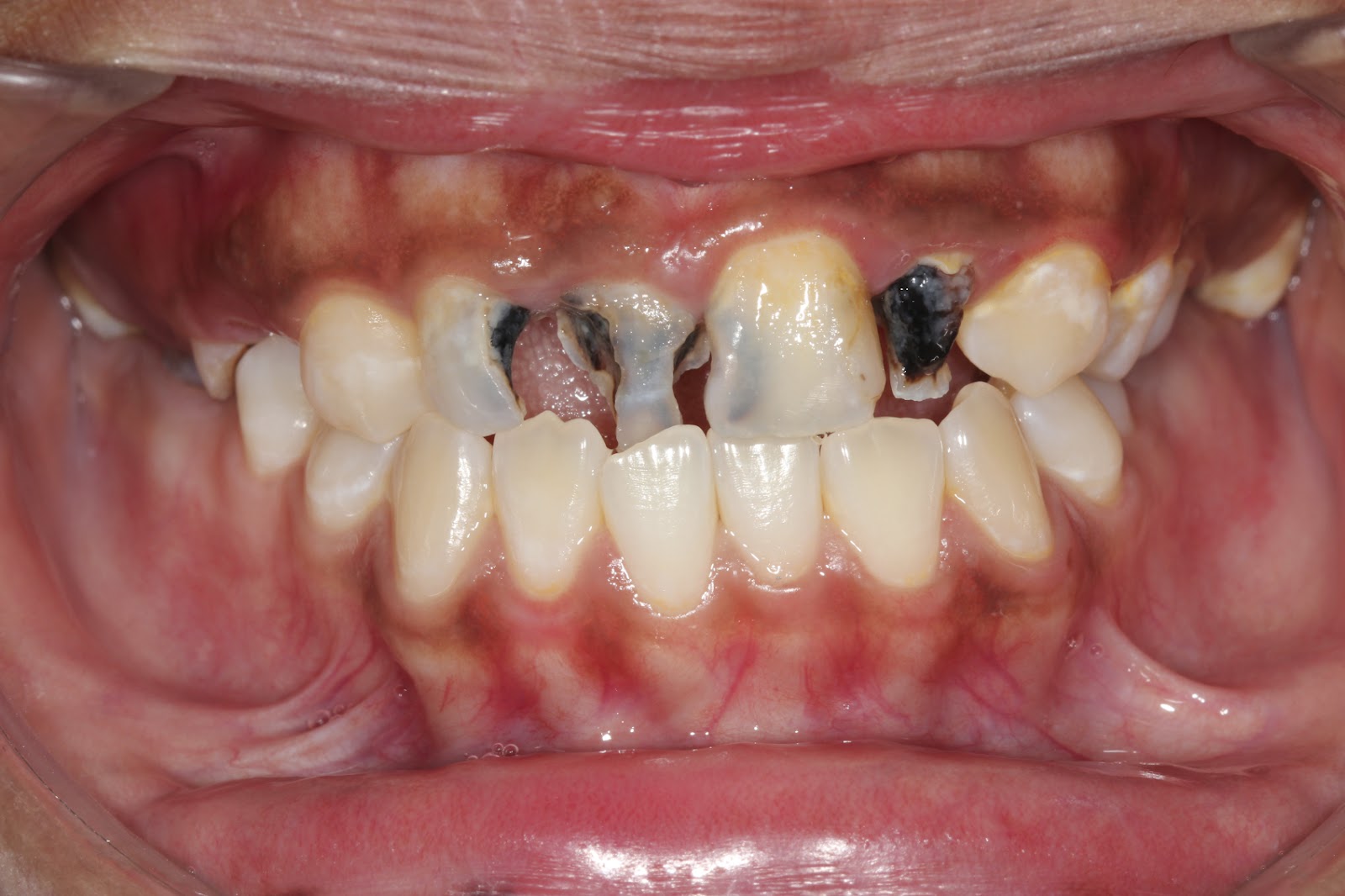 What Do Tooth Cavities Look Like