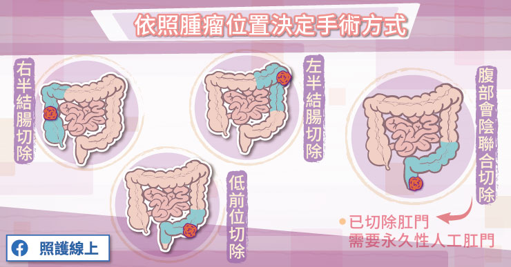 大腸直腸癌手術治療主要是依照腫瘤位置來決定手術方式