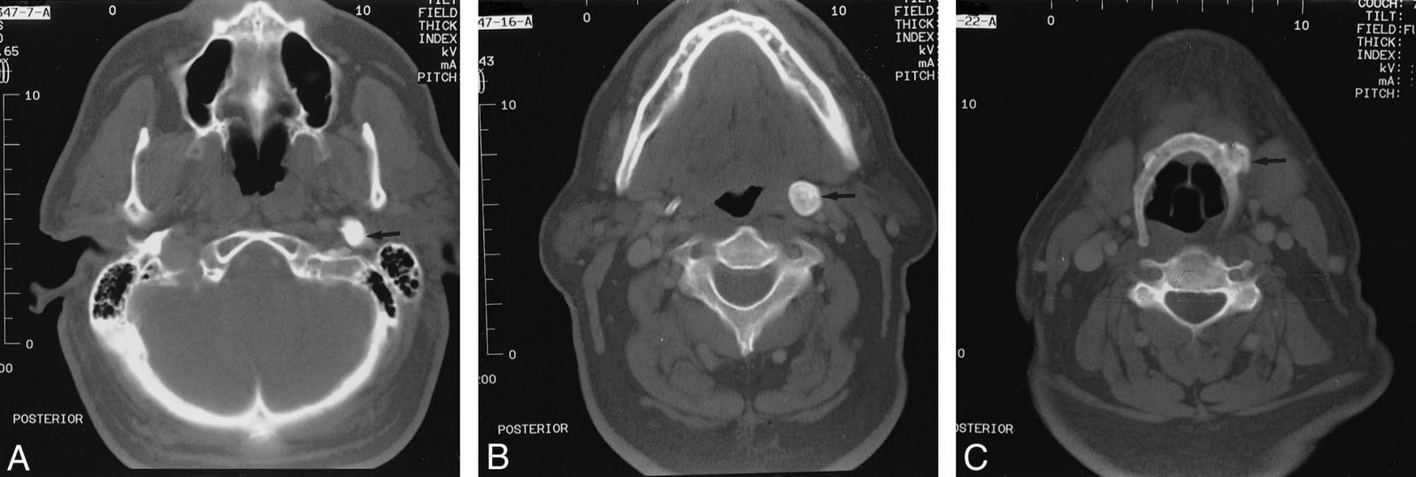Skull And Spine Eagle Syndrome Skull And Spine Eagle Syndrome