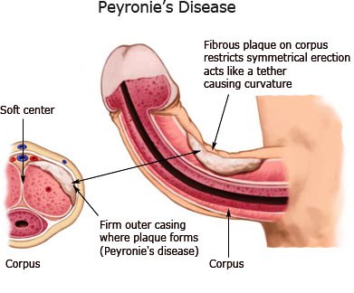 Numbness In The Penis 105