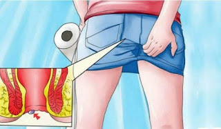 hemoroid basur belirtileri nasil