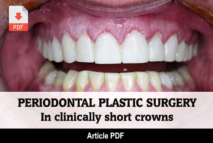PDF: Periodontal Plastic Surgery performed in clinically short crowns for prosthetic rehabilitation
