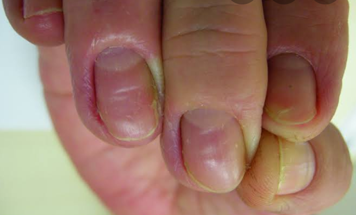 Types of Nail Diseases & treatment - Top Trends