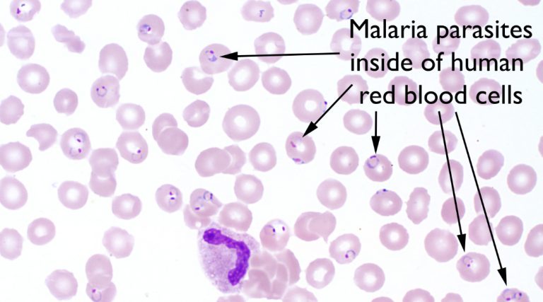 Малярия клетки. Малярия Vivax. Возбудитель малярии под микроскопом. P falciparum малярия.