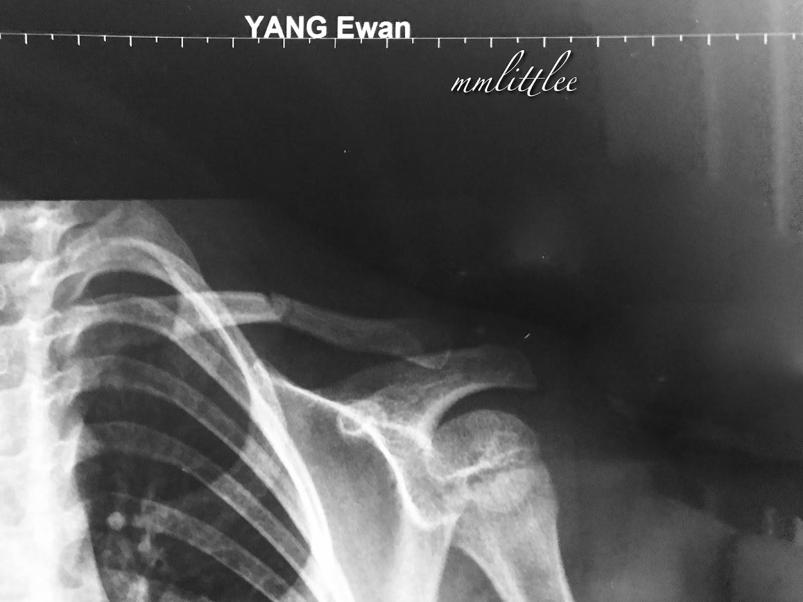 Ewan's Fractured Collarbone