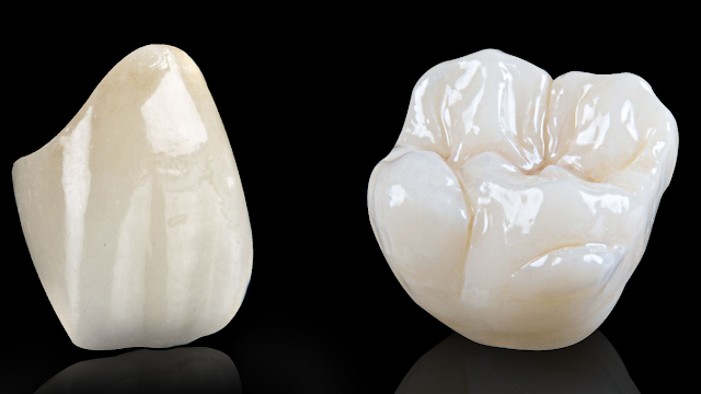 FAQ dental crown