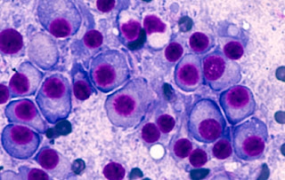  Multiple Myeloma