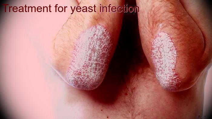 Get Rid Of Yeast Infection Fast! - The Fitness Glance