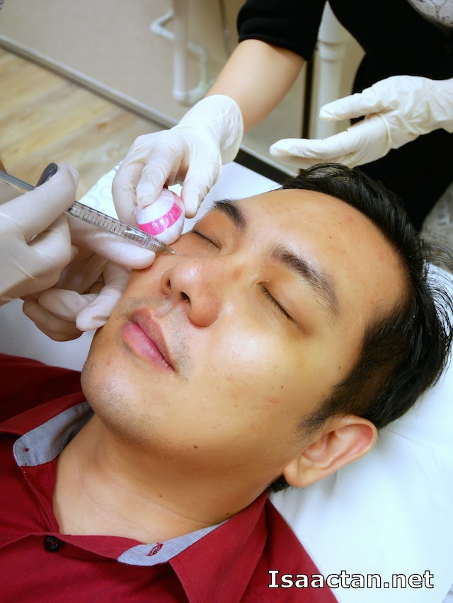 Dermafillers being injected into my face under the eye