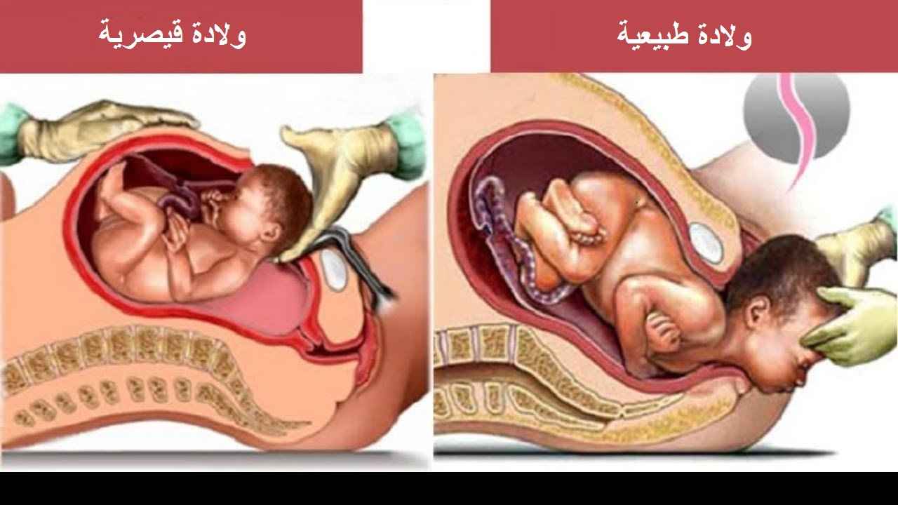 قد تكون الولادة القيصرية ضرورية عندما تشكل الولادة المهبلية خطرا على الأم أو الطفل