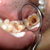 Nguyên nhân dẫn đến răng bị sâu nặng