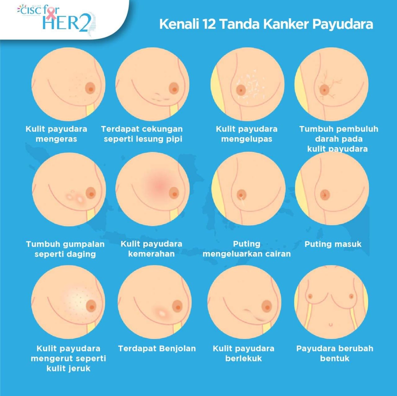 Akses Pelayanan Kesehatan Pasien Kanker Payudara HER2 -Positif di Indonesia  | Kurnia Amelia