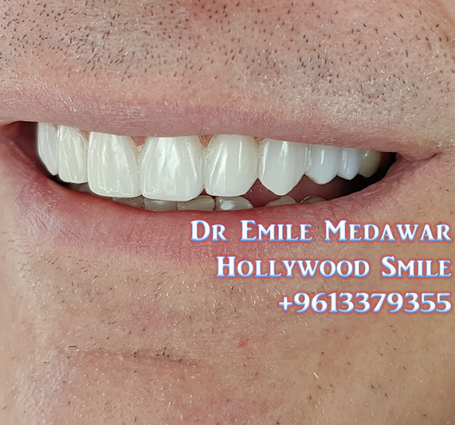 Hollywood Smile aftercare, Dr Emile Medawar, 00 961 3 379355 Aesthetic
