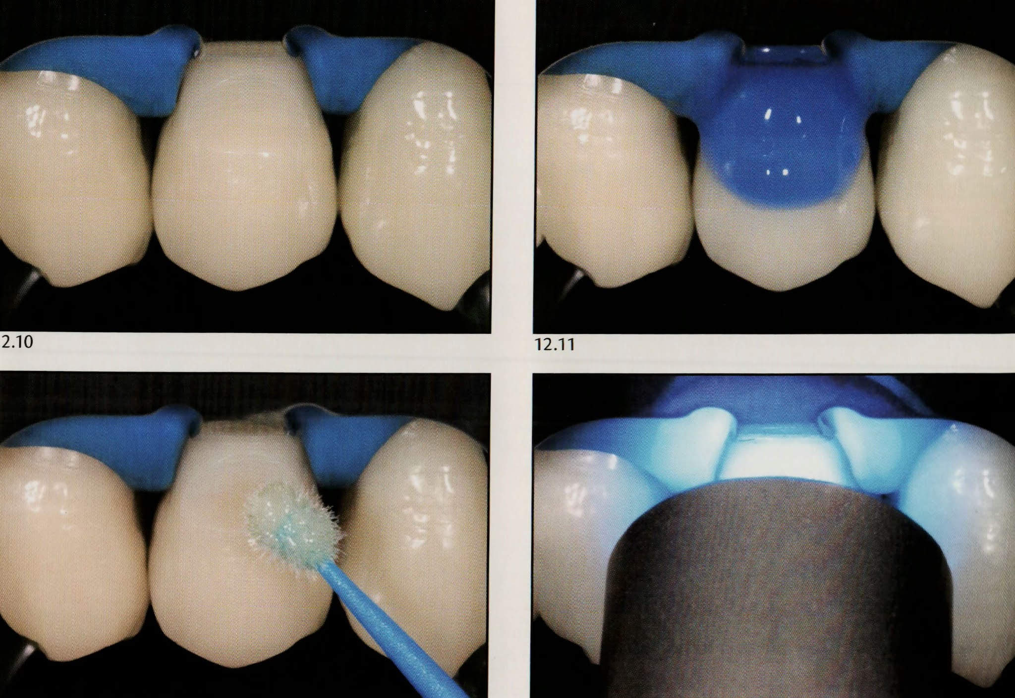 Class V composite restoration " Noncarious lesion " Dental Esthetics