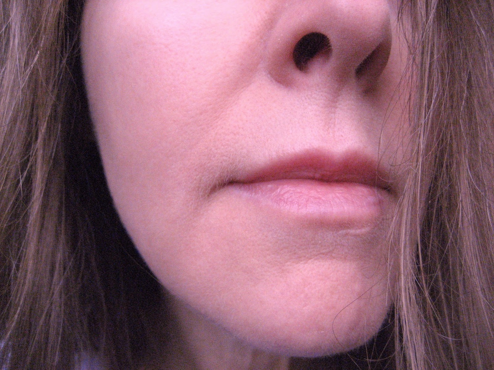 Facial peels rosacea Amateur free hot site