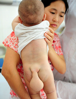 baby born with tail in china