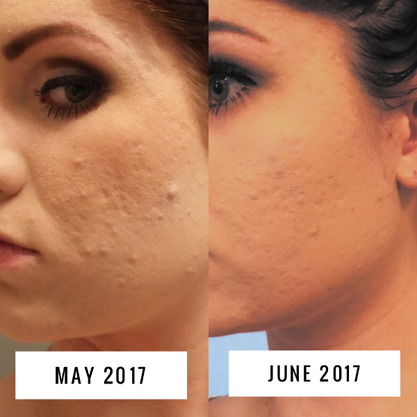 Buy accutane usa