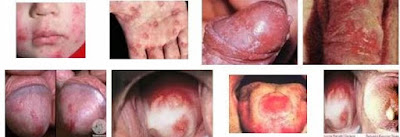 Cara mengatasi penyakit sipilis alami | obat untuk herpes ringan