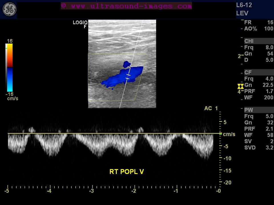 Ultrasound imaging Pulsatileflowinveins