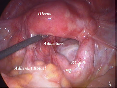 Image result for adhesion colic