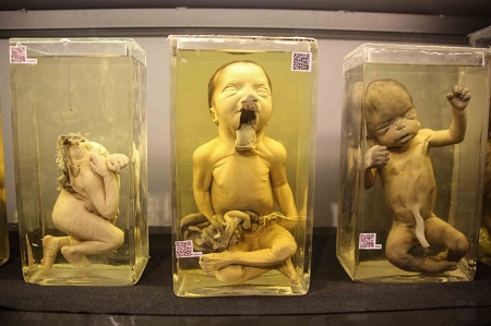 أجنة مشوهة في متحف بالقصر العيني أجنة مشوهة في متحف بالقصر العيني