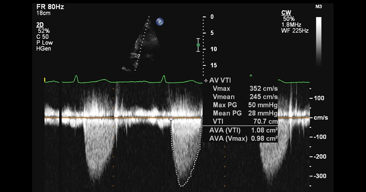 Andrew R. Houghton What's the best probe position to assess aortic