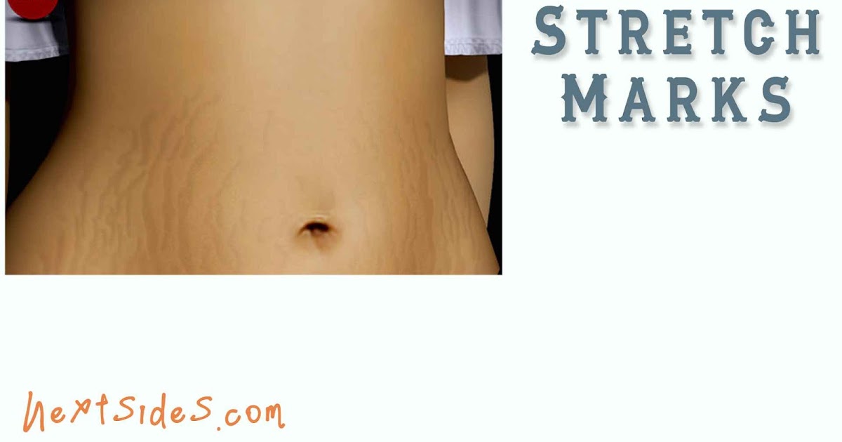 best stretch mark reducer