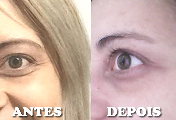 Botox natural e caseiro