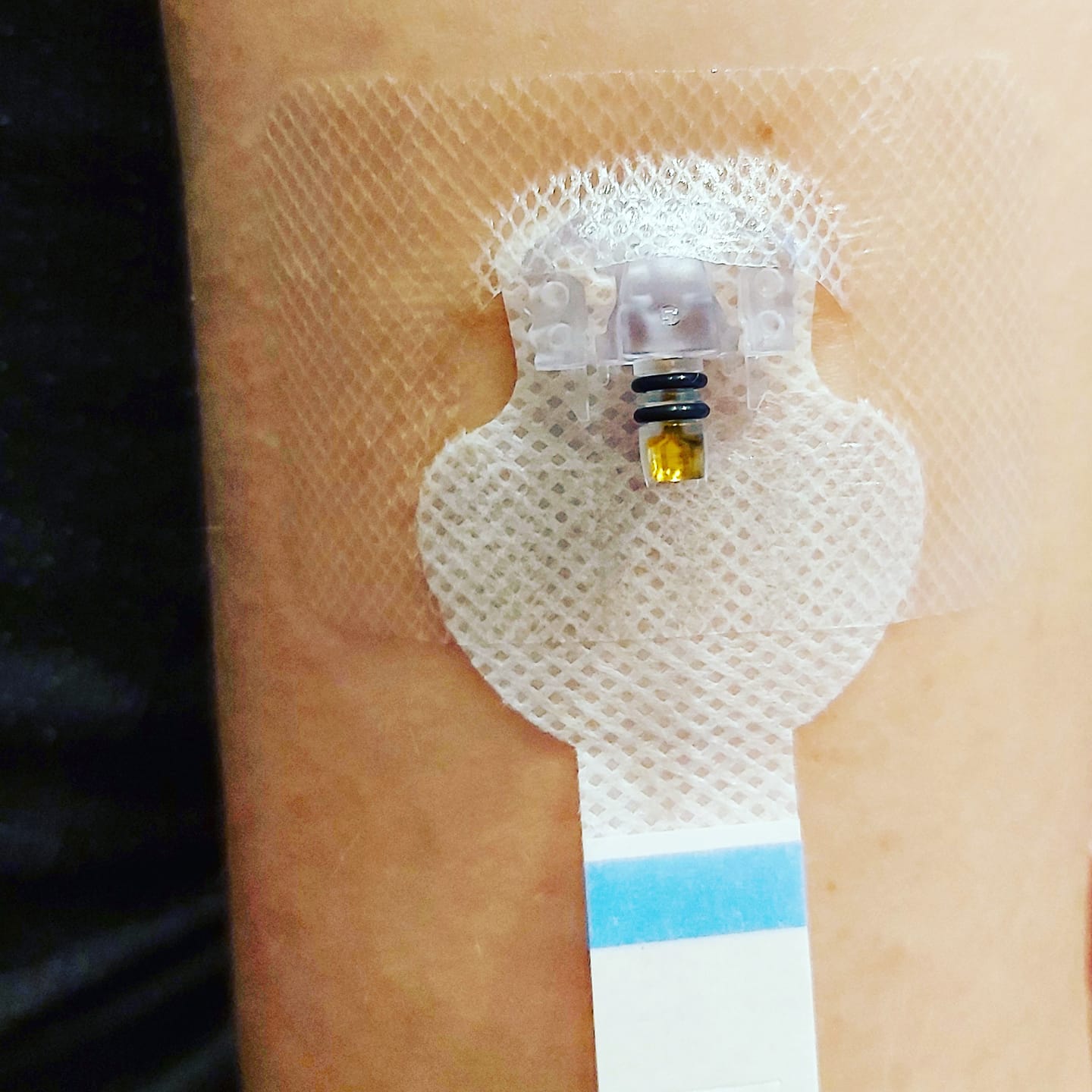 Moje doświadczenie z sensorami FreeStyle Libre, Medtronic Enlite i