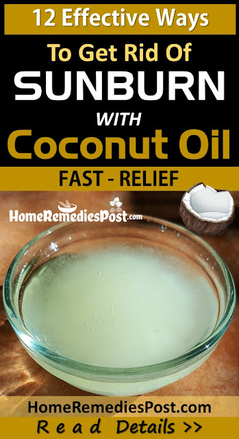 coconut oil for sunburn, How To Use Coconut Oil For Sunburn, Sunburn Treatment, how to get rid of sunburn, home remedies for sunburn