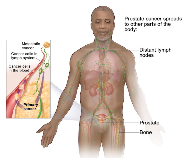 how do affect prostate cancer our body