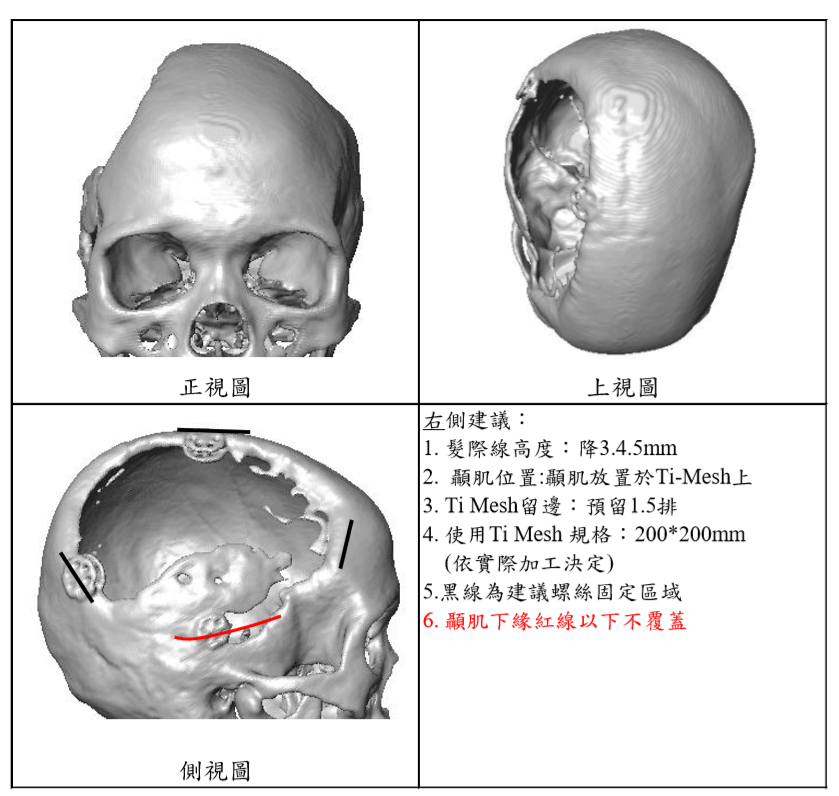 Mr Shih 施育彤醫師 開刀裝回自己的頭蓋骨也可能被吸收掉