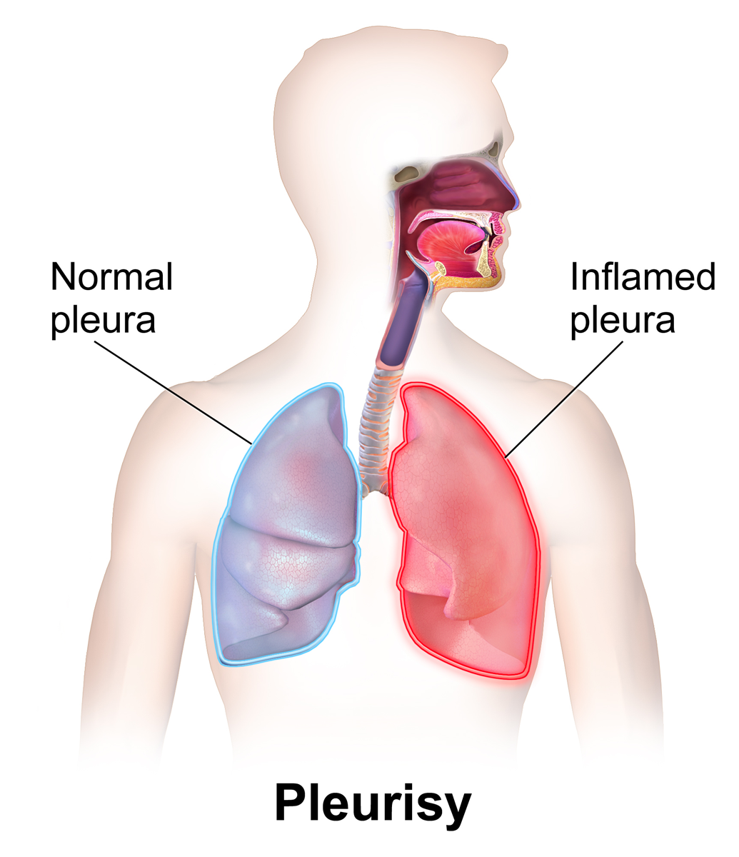 Pleurisy Is The Pain Of hitting With a sharp Knife Causes Health