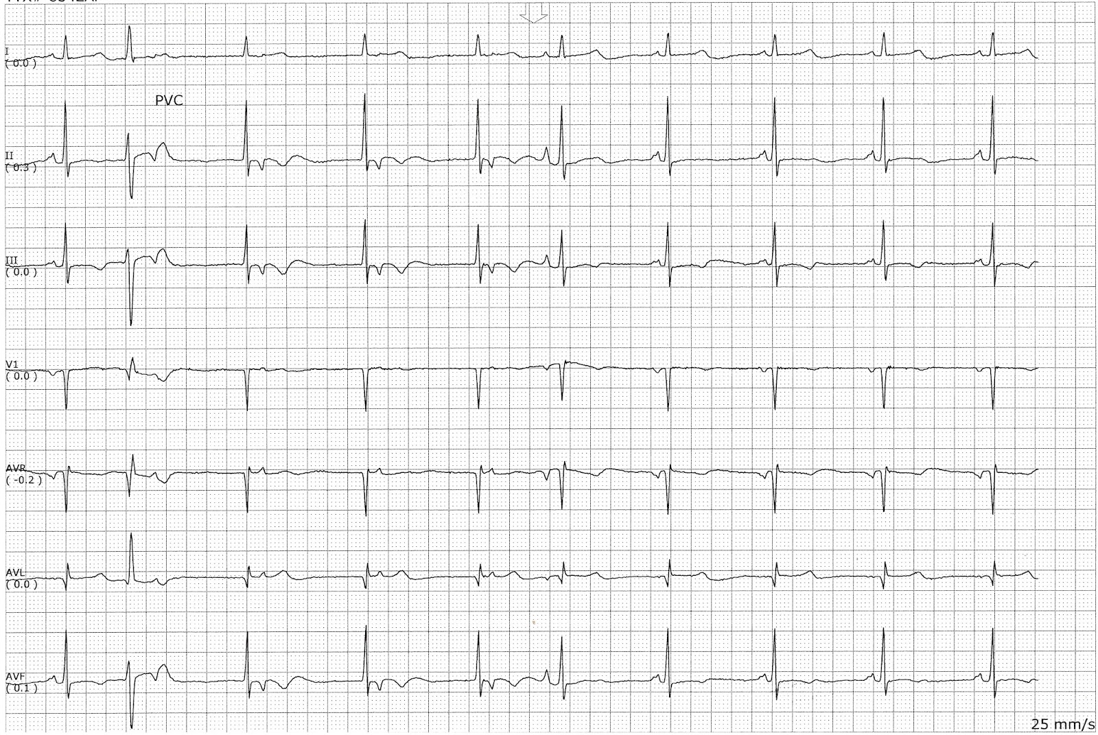 A competing junctional rhythm