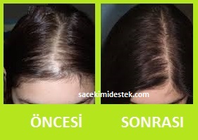 saç mezoterapisi öncesi ve sonrası 20