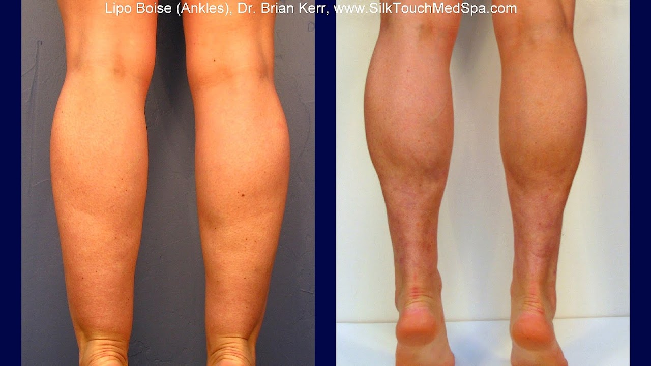 Как похудели мои щиколотки быстро