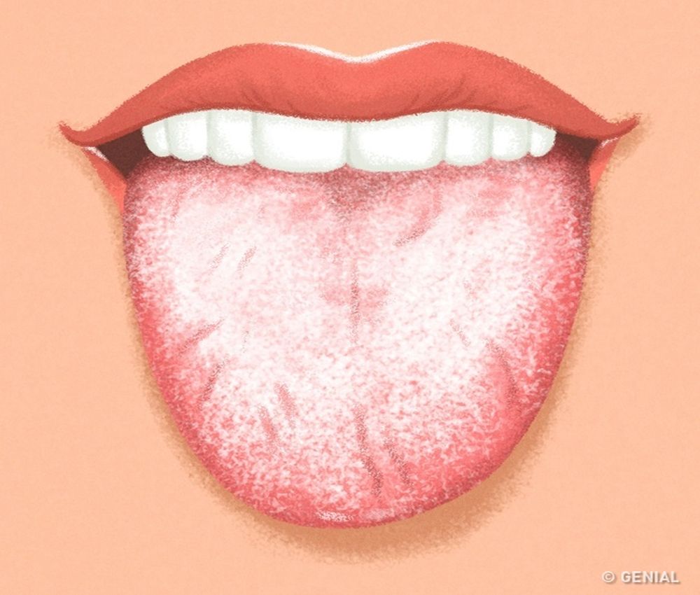 Álbumes 93+ Foto Fotos De Enfermedades De La Lengua Cena Hermosa